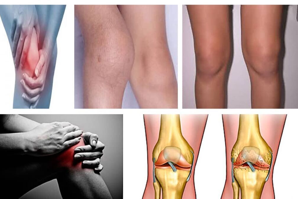 Arthrose was ist es 