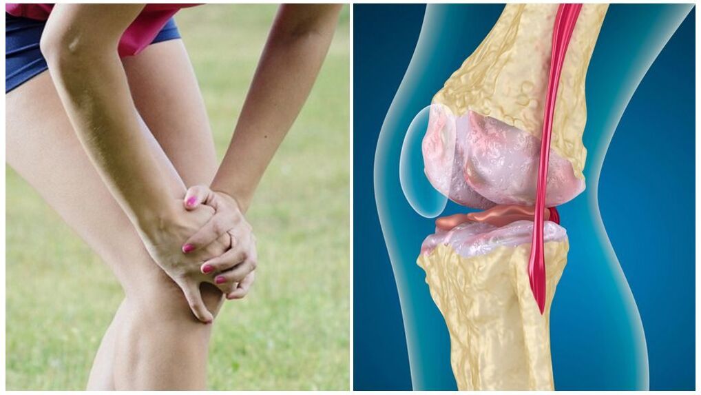 Symptome der Arthrose